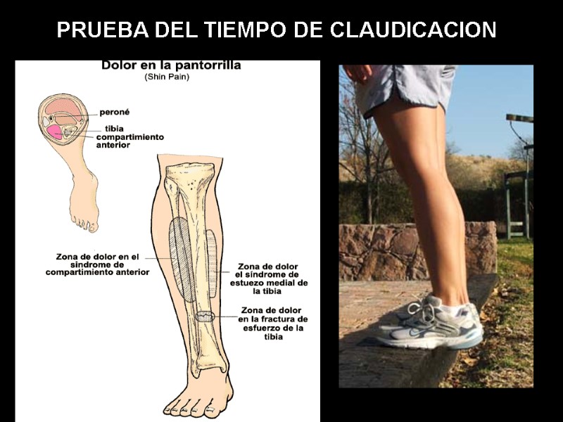 PRUEBA DEL TIEMPO DE CLAUDICACION